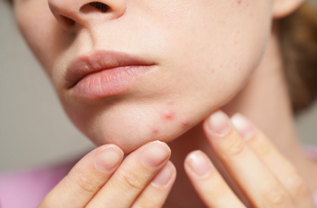 Close up of a person's chin with acne, with the person's fingers touching the skin.