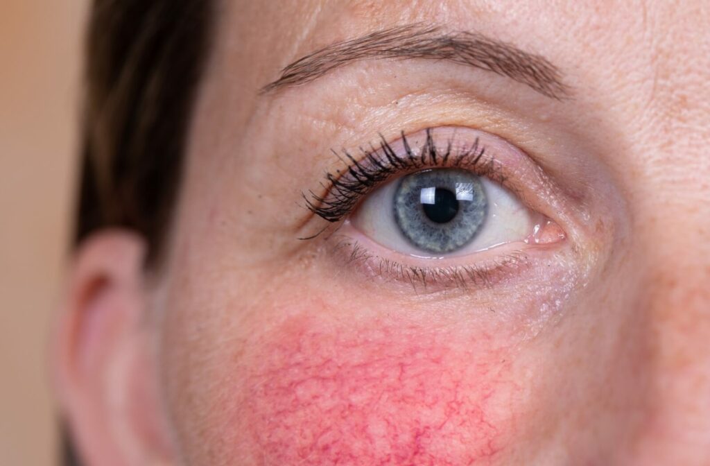 Close-up of a person's eye with redness on the cheek underneath.